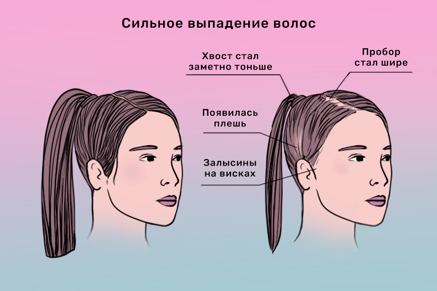Почему выпадают волосы весной: причины, дефициты и что делать при сильном выпадении